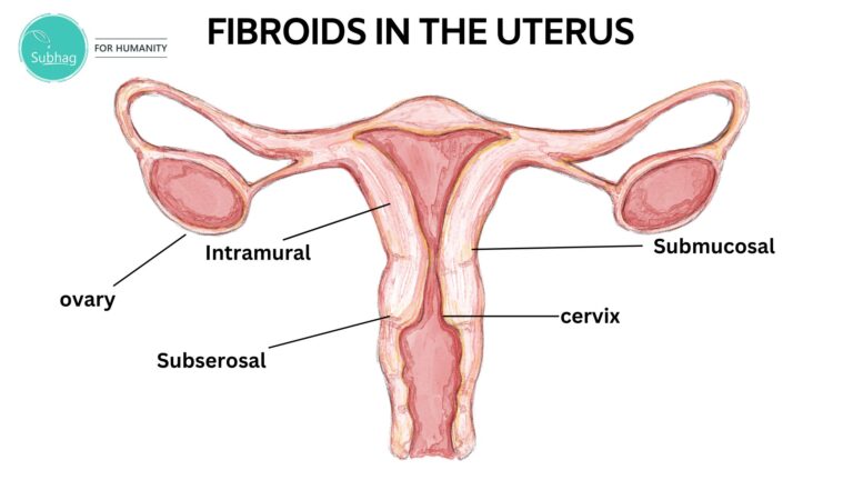 Fibroids in the Uterus